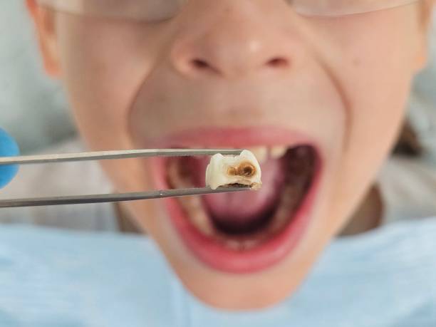 Best Emergency Treatment for Dental Infections or Abscesses in Glenwood City, WI